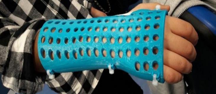 Medicina e innovazione: plastica al posto del gesso Medicina e innovazione: plastica al posto del gesso